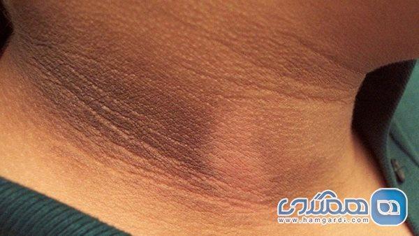 ژنتیک؛ مهمترین عامل ایجاد تیرگی پوست ژنتیک؛ مهمترین عامل ایجاد تیرگی پوست